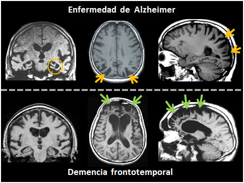 alzheimer