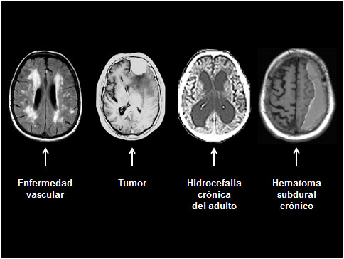 enfermedad mental degenerativa